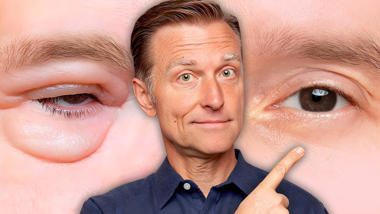Bebis påsar under ögonen: 5 effektiva botemedel du bör testa 3 bebis påsar under ögonen