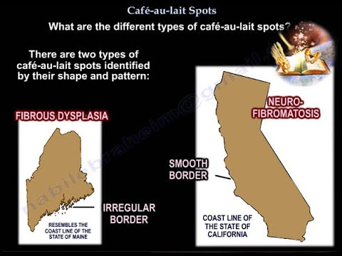Cafe au lait fläckar 7 saker du bör veta om dem 1 cafe au lait fläckar