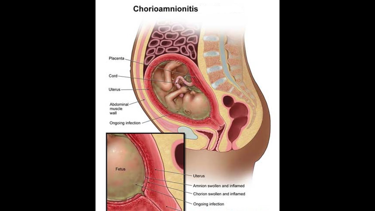 Chorioamnionit 7 viktiga fakta du behöver känna till 3 chorioamnionit