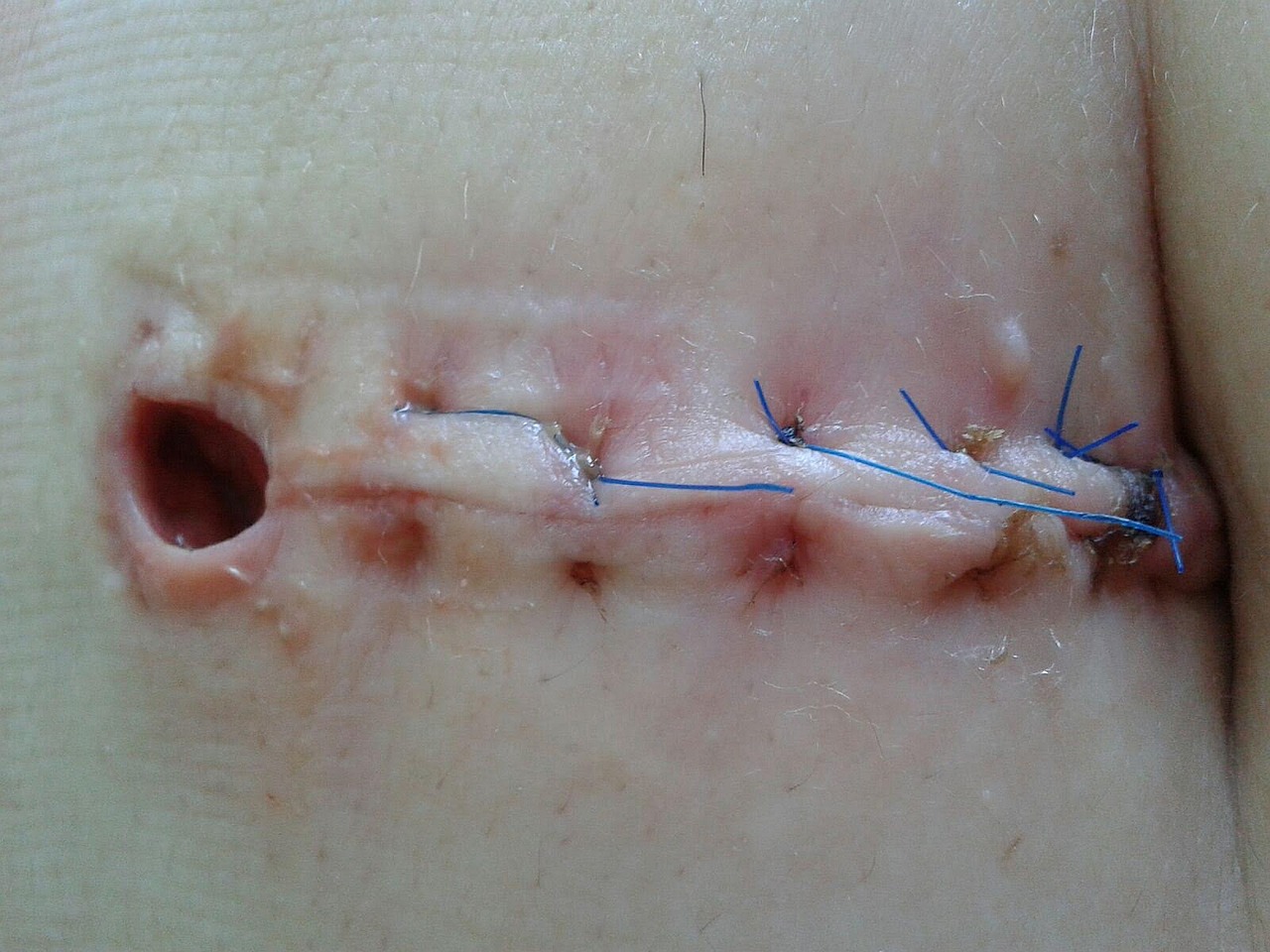 Necrosis: 5 señales clave que indican su presencia en el cuerpo 4 necrosis