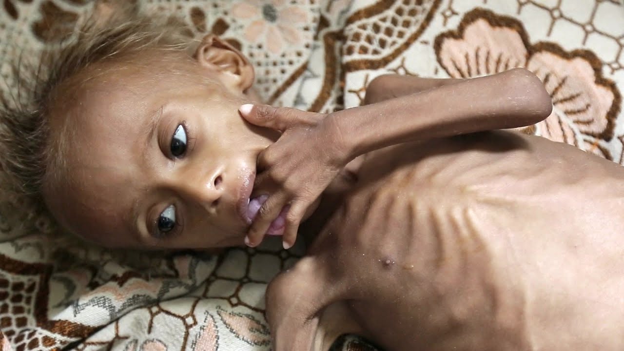 Niños desnutridos de África: 7 realidades impactantes hoy 1 niños desnutridos de africa